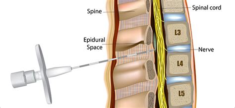 How Long Does It Take An Epidural Spinal Injection To Work