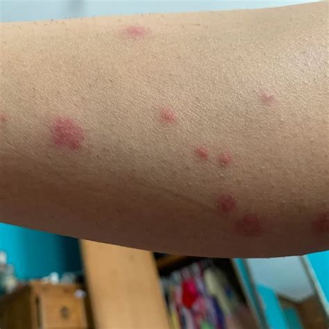 How Long Does It Take Bed Bug Bites To Develop