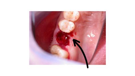 How Long Does It Take For A Blood Clot To Form After Getting A Tooth Pulled
