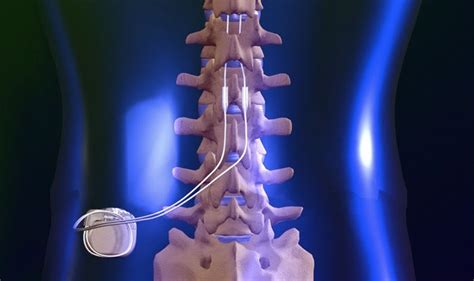 How Long Does It Take For A Spinal Cord Stimulator To Work