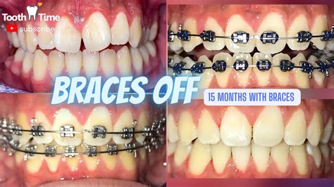 how long does it take for a tooth to shift with braces
