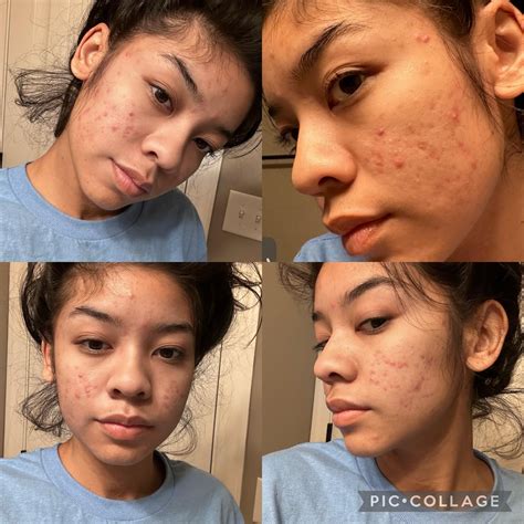 how long does it take for doxycycline to work for acne reddit