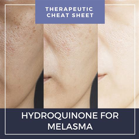 how long does it take for hydroquinone to work on melasma