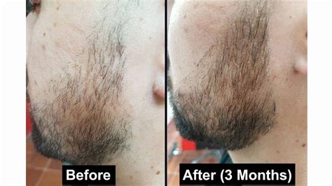 how long does it take for rogaine to work on beard