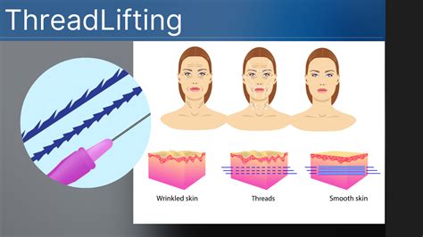 How Long Does It Take For Thread Lift To Work