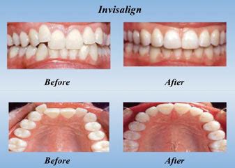 how long does it take for your teeth to get used to invisalign
