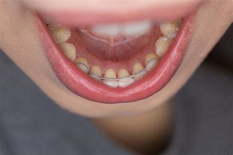 How Long Does It Take To Break In A Retainer