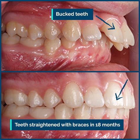 How Long Does It Take To Correct Overbite With Braces