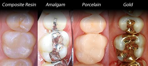 how long does it take to do 3 fillings