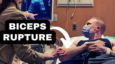 how long does it take to fully recover from bicep tendon surgery