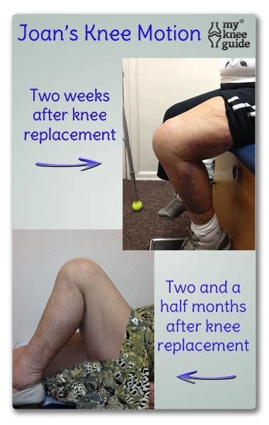 How Long Does Knee Manipulation Take