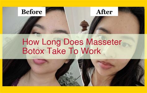 how long does masseter botox take to work reddit