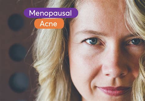 How Long Does Menopause Acne Last?