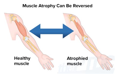 how long does muscle atrophy take to occur