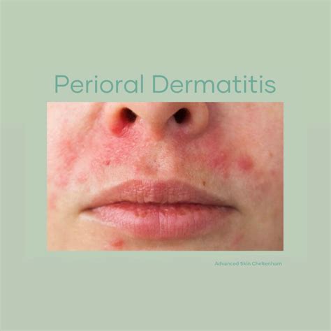 how long does perioral dermatitis take to develop
