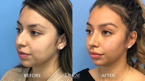 how long does rhinoplasty recovery take