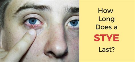 How Long Does a Stye Last: Understanding the Duration and Treatment Options