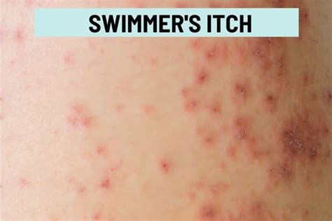 How Long Does Swimmer's Itch Take To Develop