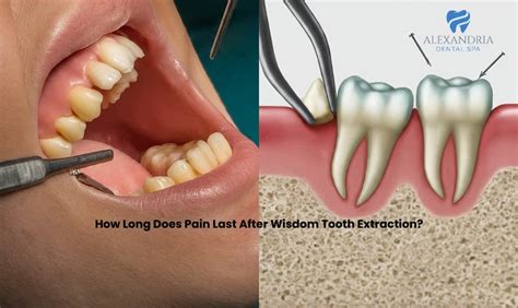 how long does wisdom tooth ache last