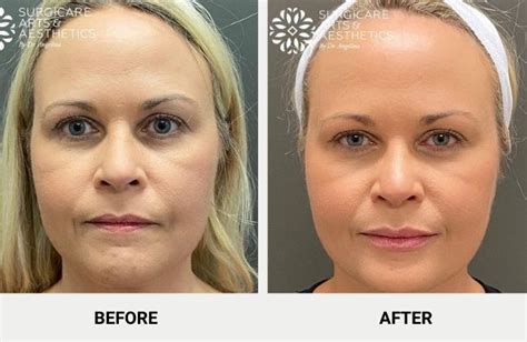 how long for botox to settle in forehead