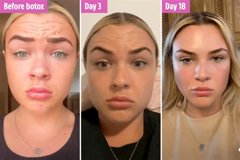 how long for botox to work in forehead