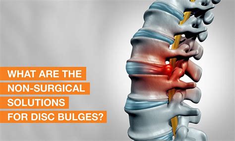 how long for bulging disc to heal without surgery
