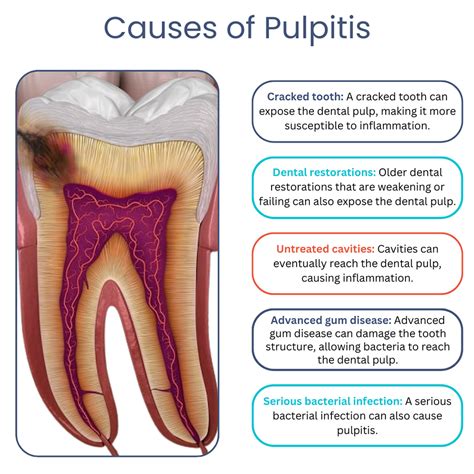 how long for pulpitis to settle