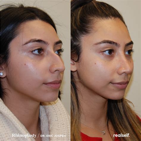 how long is recovery from rhinoplasty