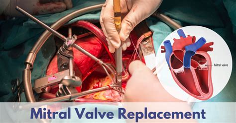 How Long is Valve Replacement Surgery? A Comprehensive Guide to Duration & Recovery