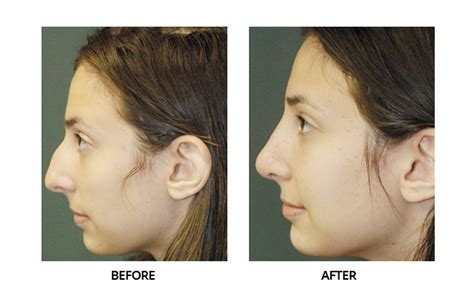 how long rhinoplasty surgery take