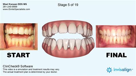 how long to fix open bite with invisalign