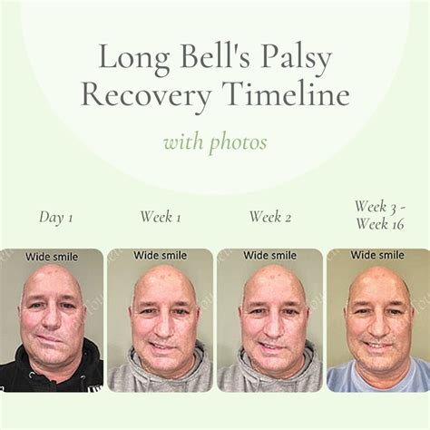 how long to recover from bell's palsy