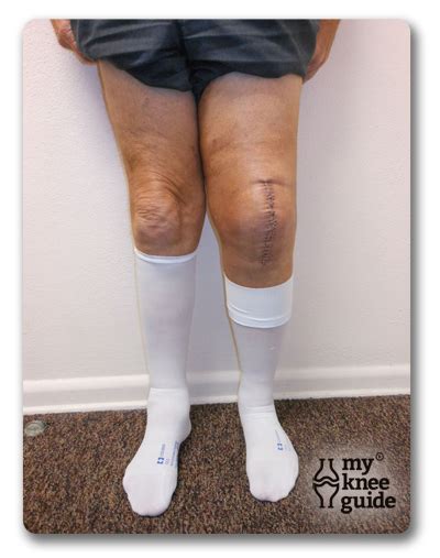 how long to wear compression socks after total knee replacement
