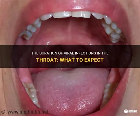 How Long Does a Viral Infection Last: Understanding the Timeline