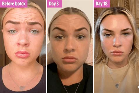 how long will botox take to work