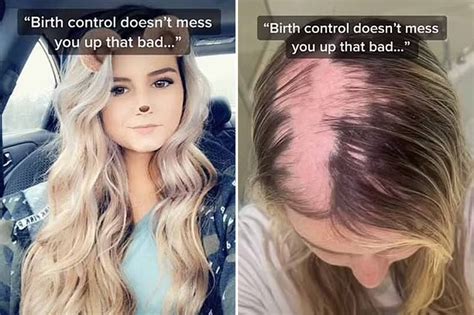 How Long Will Hair Fall Out After Stopping Birth Control 