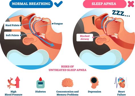 how many apneas is normal
