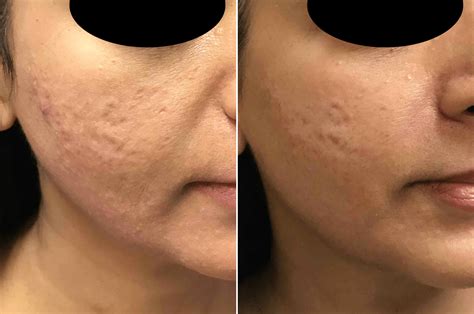 How Many Microneedling Sessions for Acne Scars: The Ultimate Guide