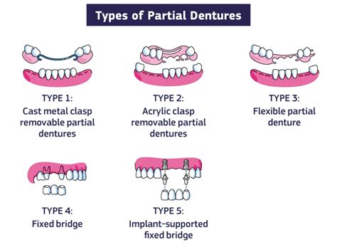 How Many Type Of Removable Partial Denture