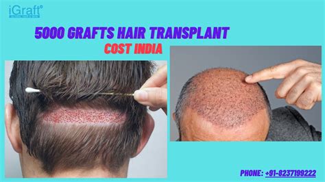  79 Popular How Much A Hair Transplant Cost In India With Simple Style