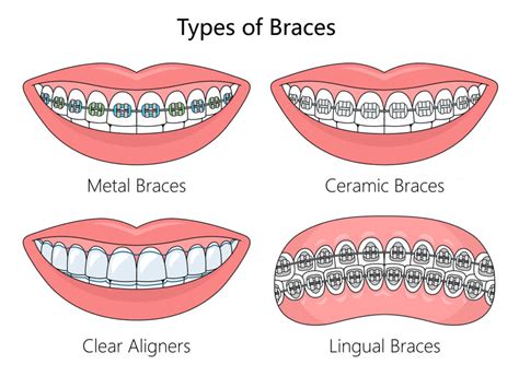 How Much Are Bottom.braces