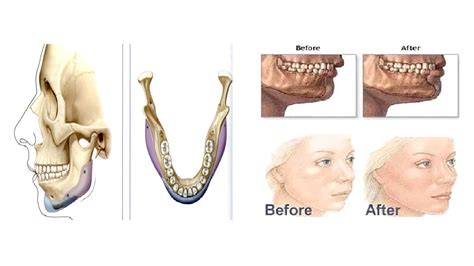 how much are jaw implants