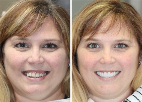 how much do veneers cost for front teeth