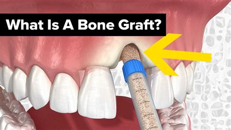 how much does bone replacement graft cost