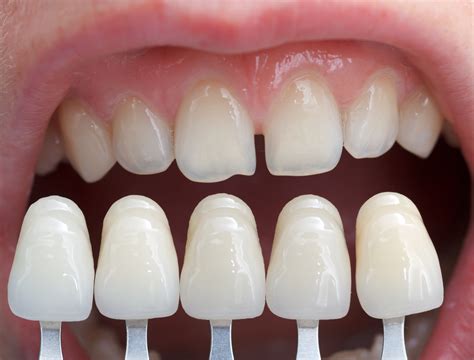 how much does composite resin cost per tooth