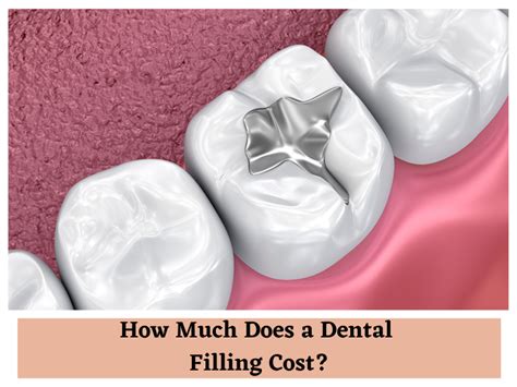 how much does it cost to fill a hole in a tooth