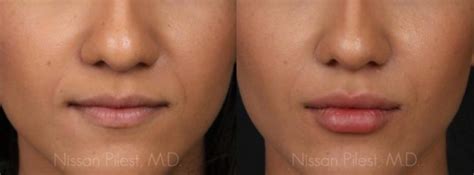 how much does juvederm cost at laseraway