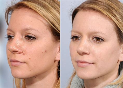 how much does laser mole removal cost