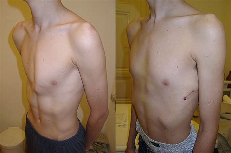 how much does pectus carinatum surgery cost