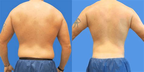 how much does sonobello cost